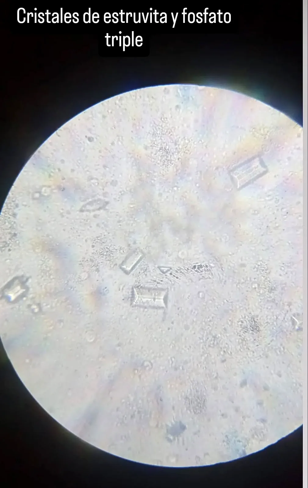 Cristales de estruvita (fosfato triple) vistos al microscopio en un análisis de orina