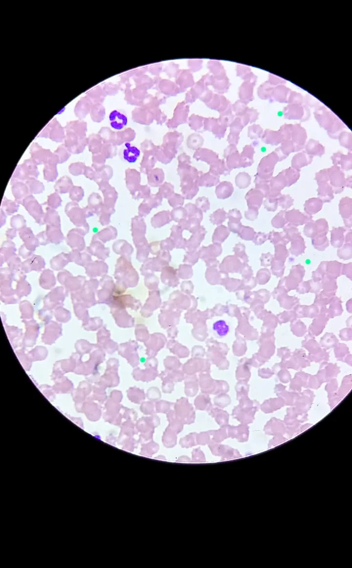 Frotis de sangre al microscopio: glóbulos rojos y glóbulos blancos